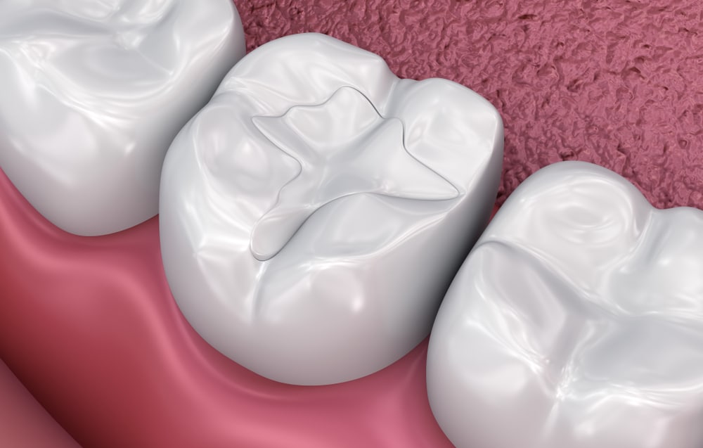 dental fillings in Winnipeg