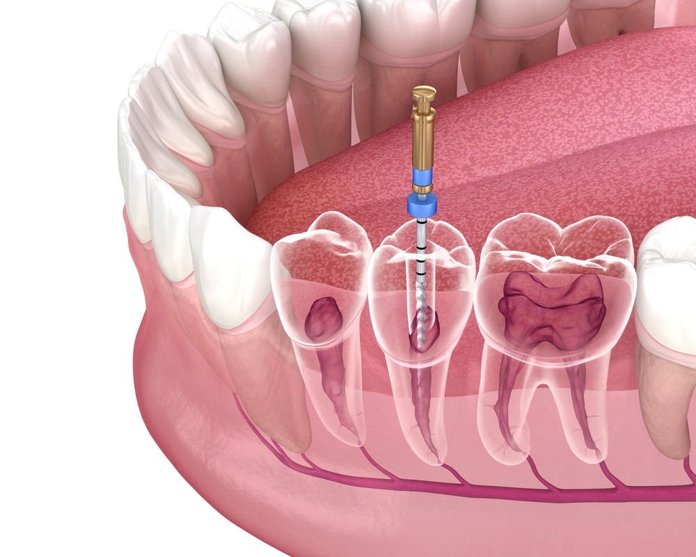 root canals in Winnipeg