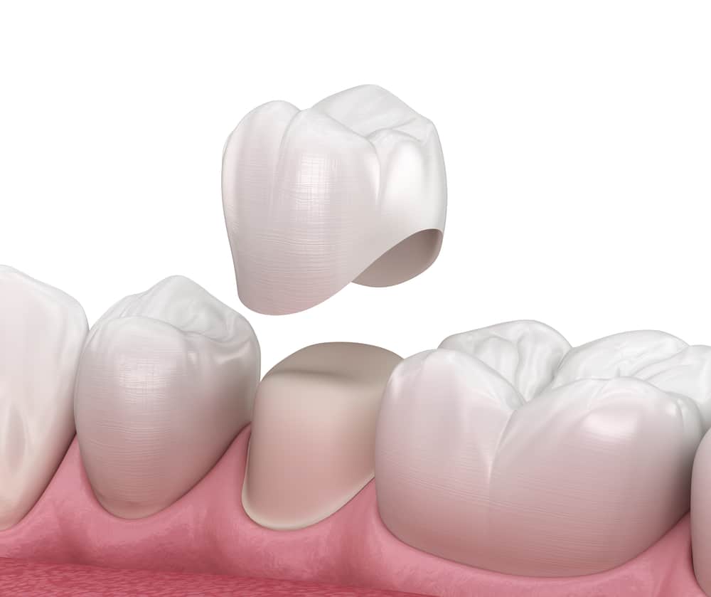 dental crown in winnipeg