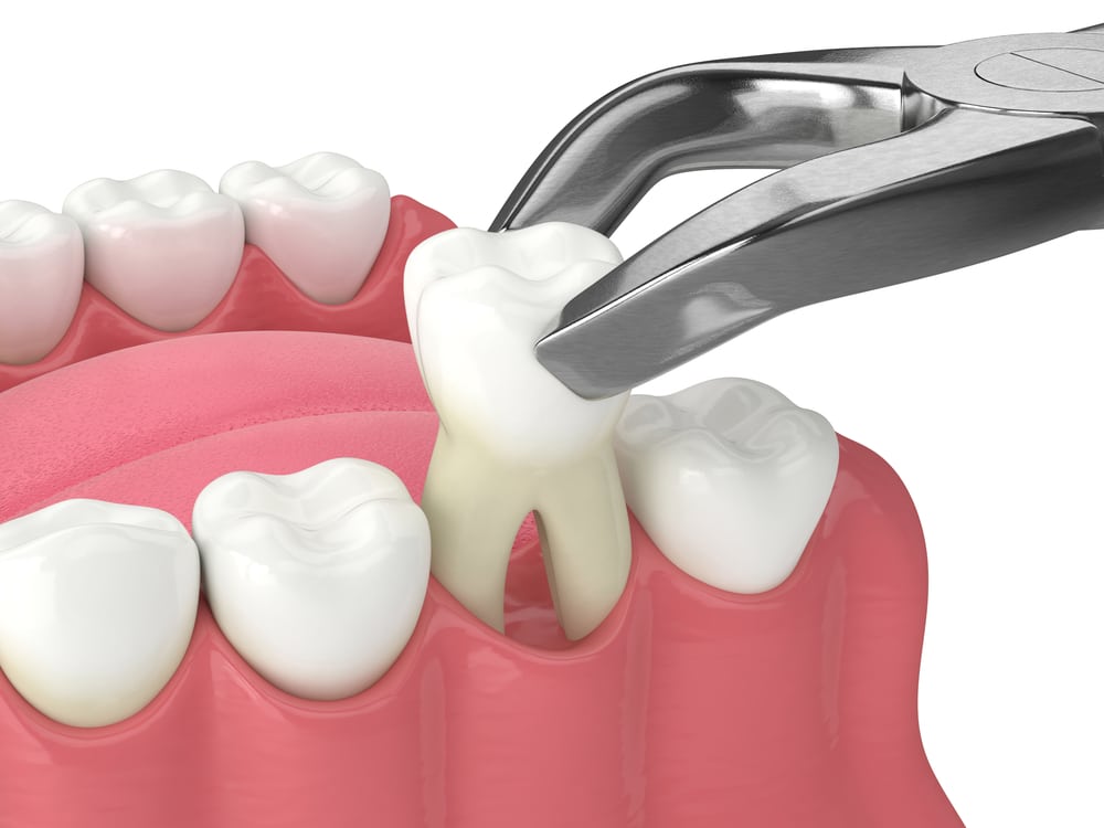 Tooth Extraction in winnipeg