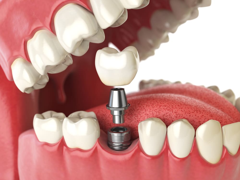 example of dental implant in winnipeg