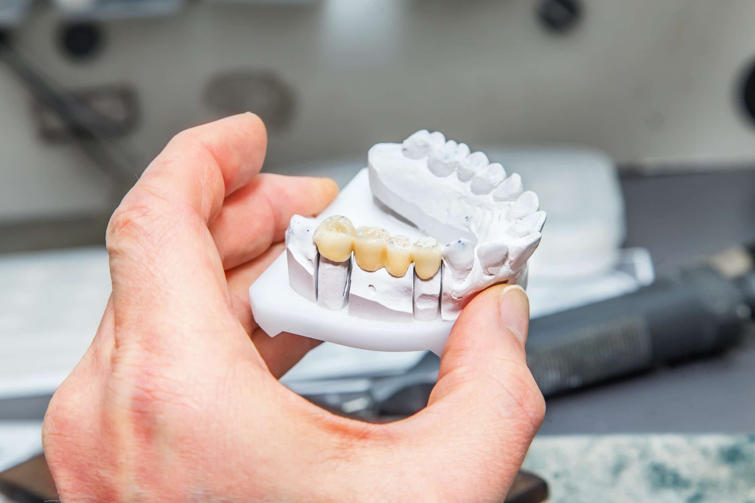 Read more about the article Can a Dental Bridge Replace Multiple Missing Teeth? What You Need to Know